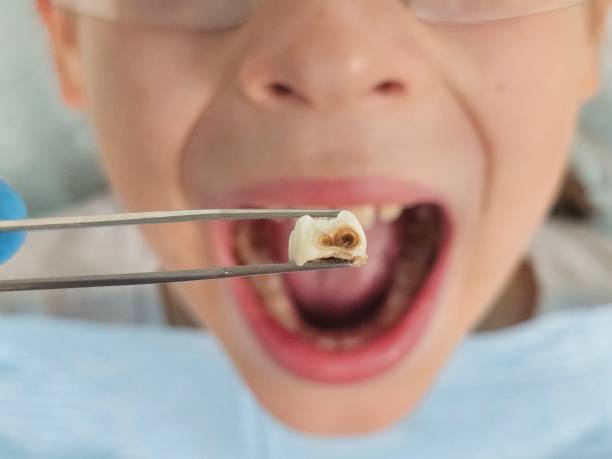Best Emergency Wisdom Teeth Removal in Durham, NC